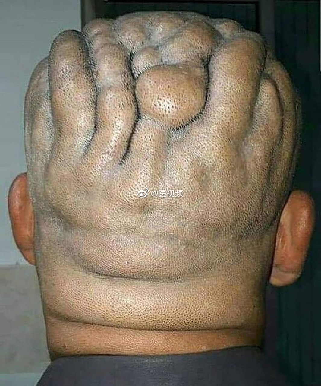 厚皮厚骨膜综合征