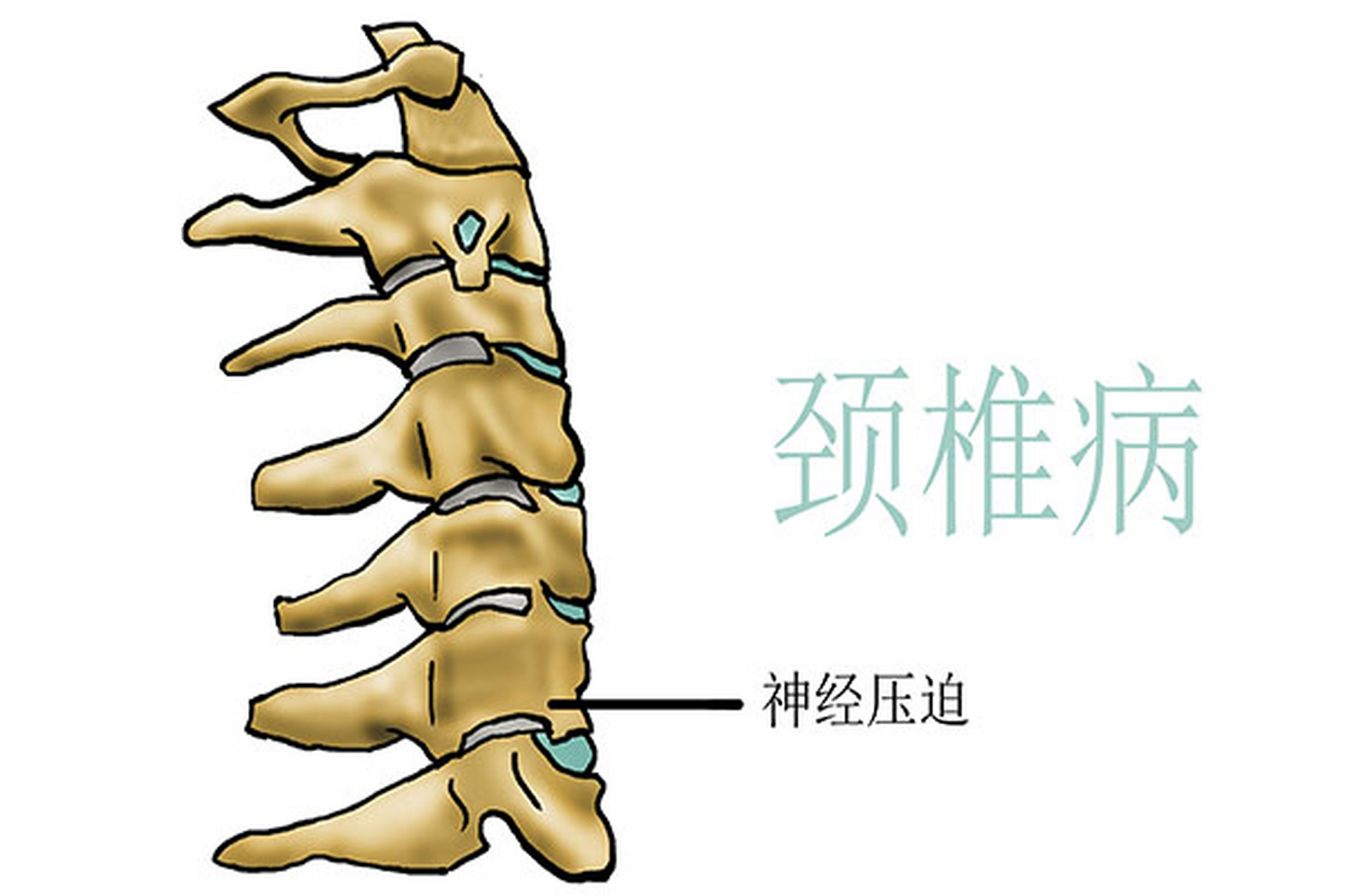 【颈椎病的8个警报#每日健康科普知识 1,久治不愈的头痛或偏头痛