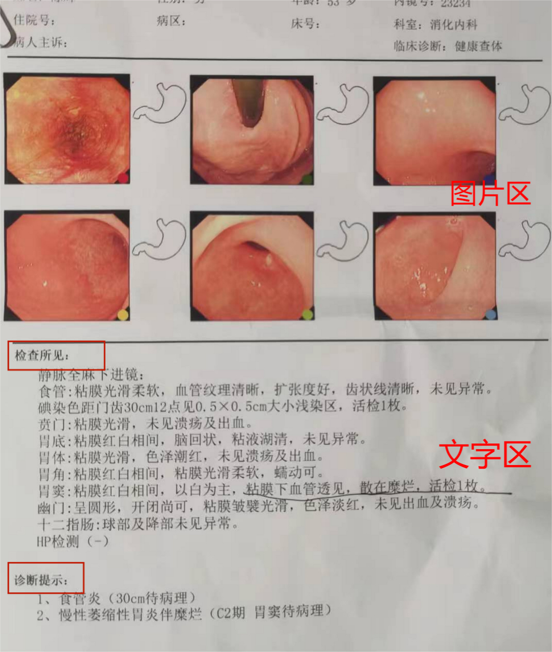 胃镜检查结果正常图片图片