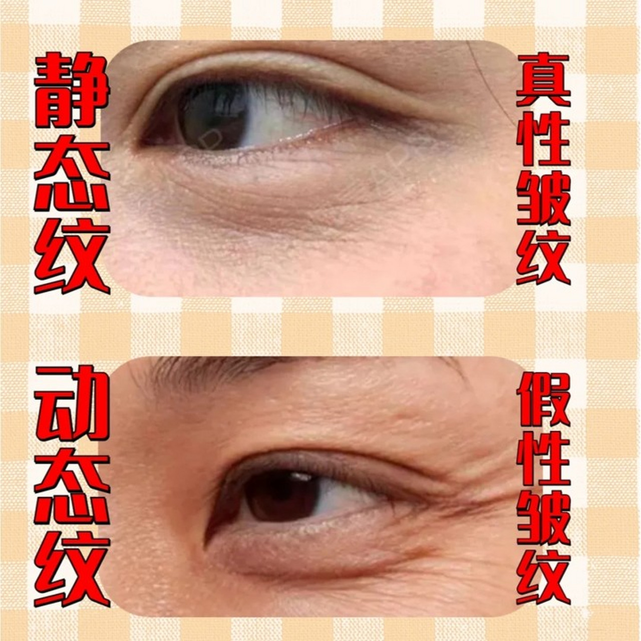 如何分辨动态纹和静态纹?