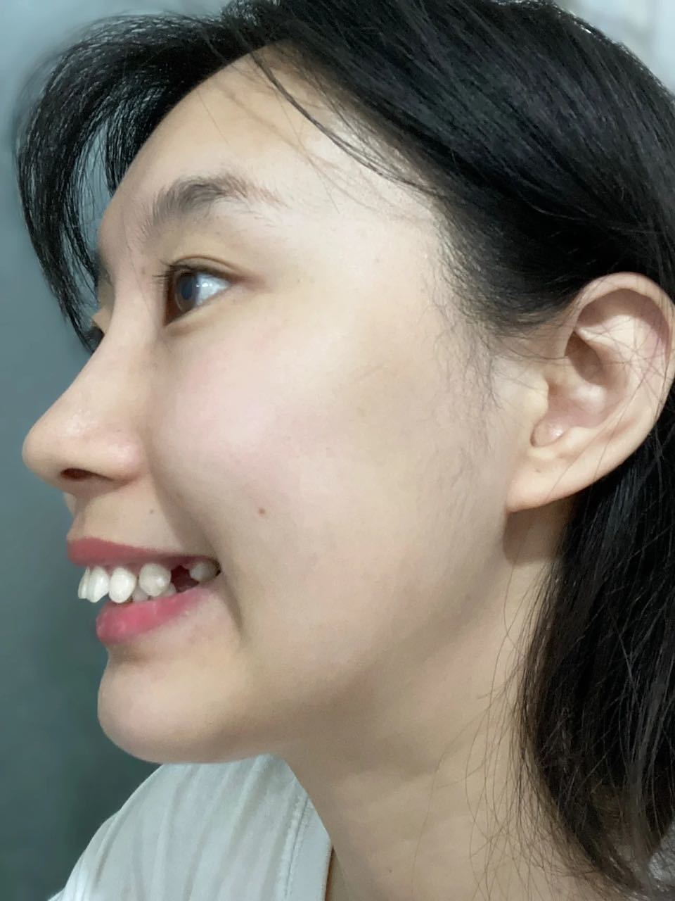 27岁小姐姐,前牙严重外凸,一直相亲失败,矫正后:简直像换了个人 广东