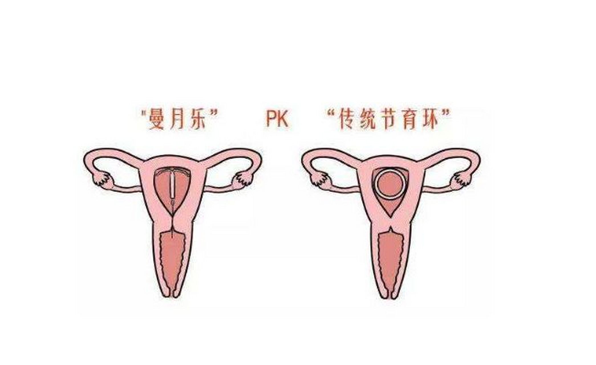 曼月乐环对治疗"腺肌症"有用?