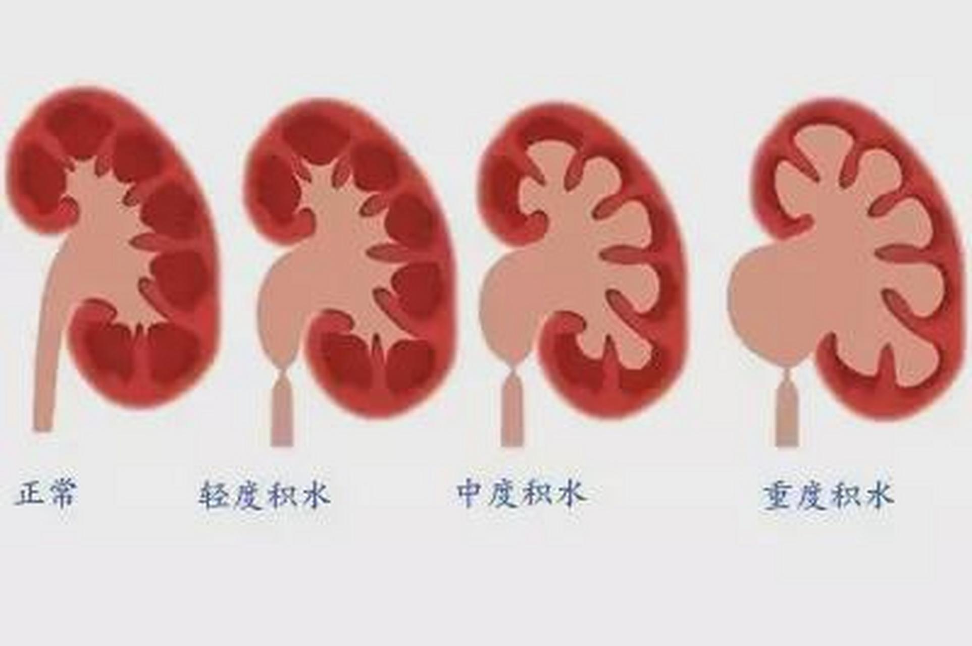 肾积水严重吗图片