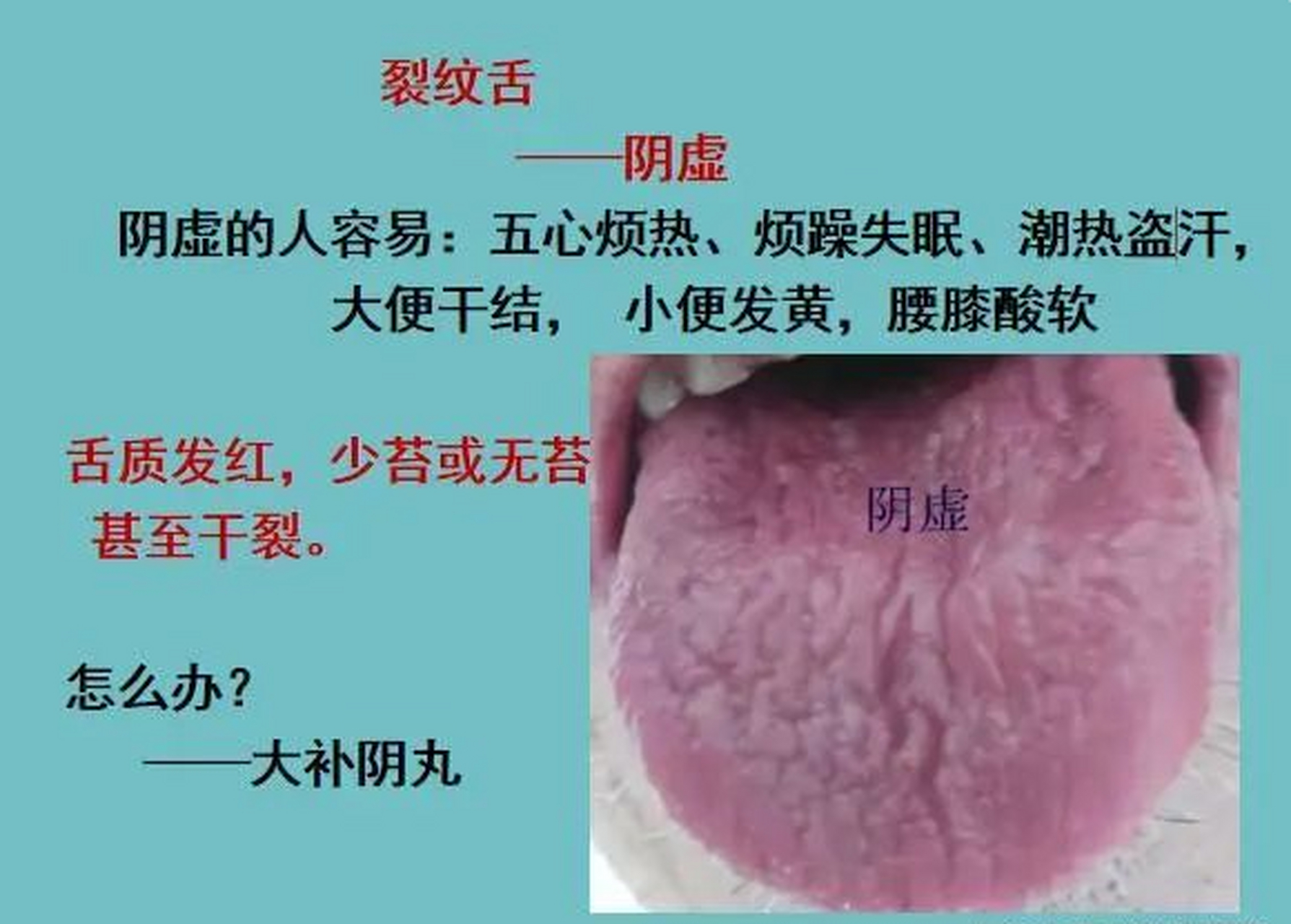 裂纹舌,舌头伸出来,有一条一条很深的裂纹,而且有的是舌前裂,有的是舌