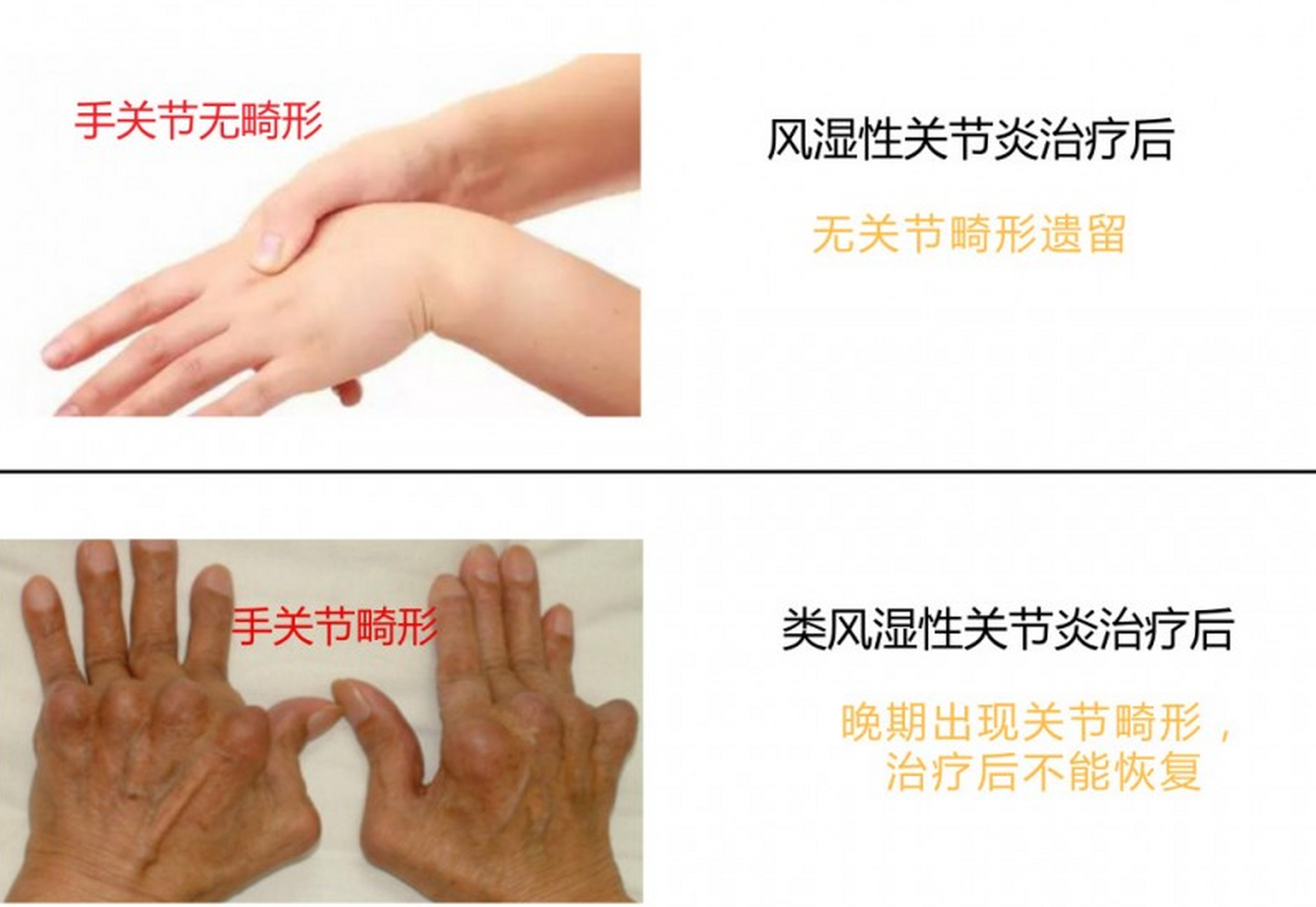 罗医生带您快速了解风湿和类风湿 (1)风湿的发病原因可能与遗传,感染