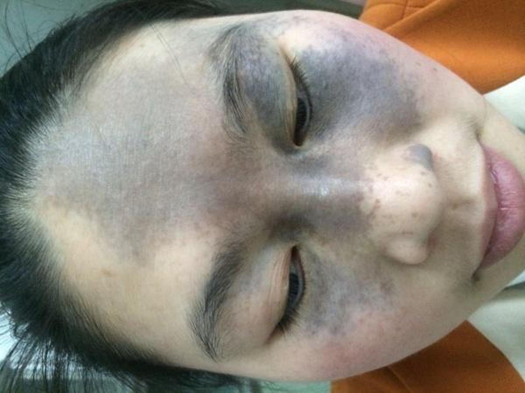 太田痣会有2个发病高峰期,第一个高峰期是在0-1岁之间,第二个高峰期