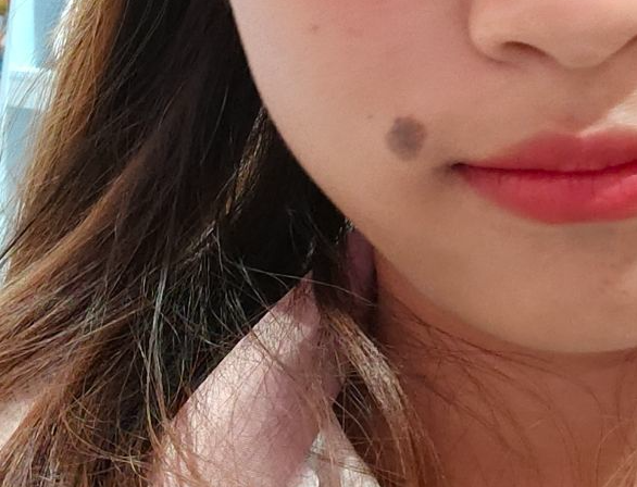 "身上突然长了黑色痣,是不是病变了?