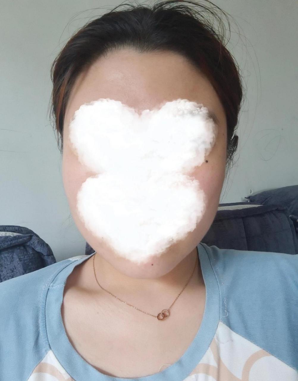 day6瘦脸针第六天注射瘦脸针仿佛又有所减小,或许只是心理作用.