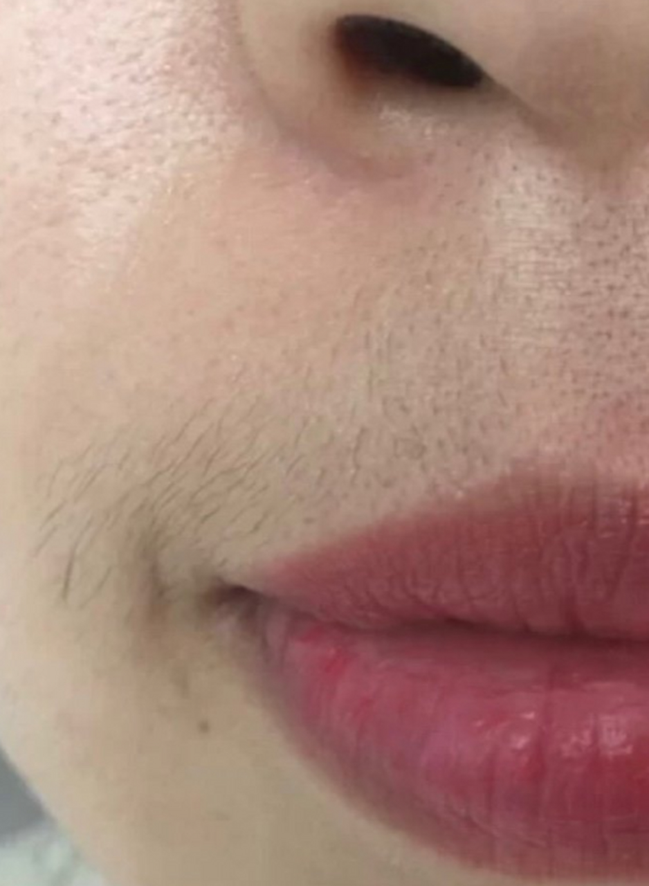 脱唇毛# 脸上长毛 怎么去除 谁不希望拥有一个洁净的面容呢?
