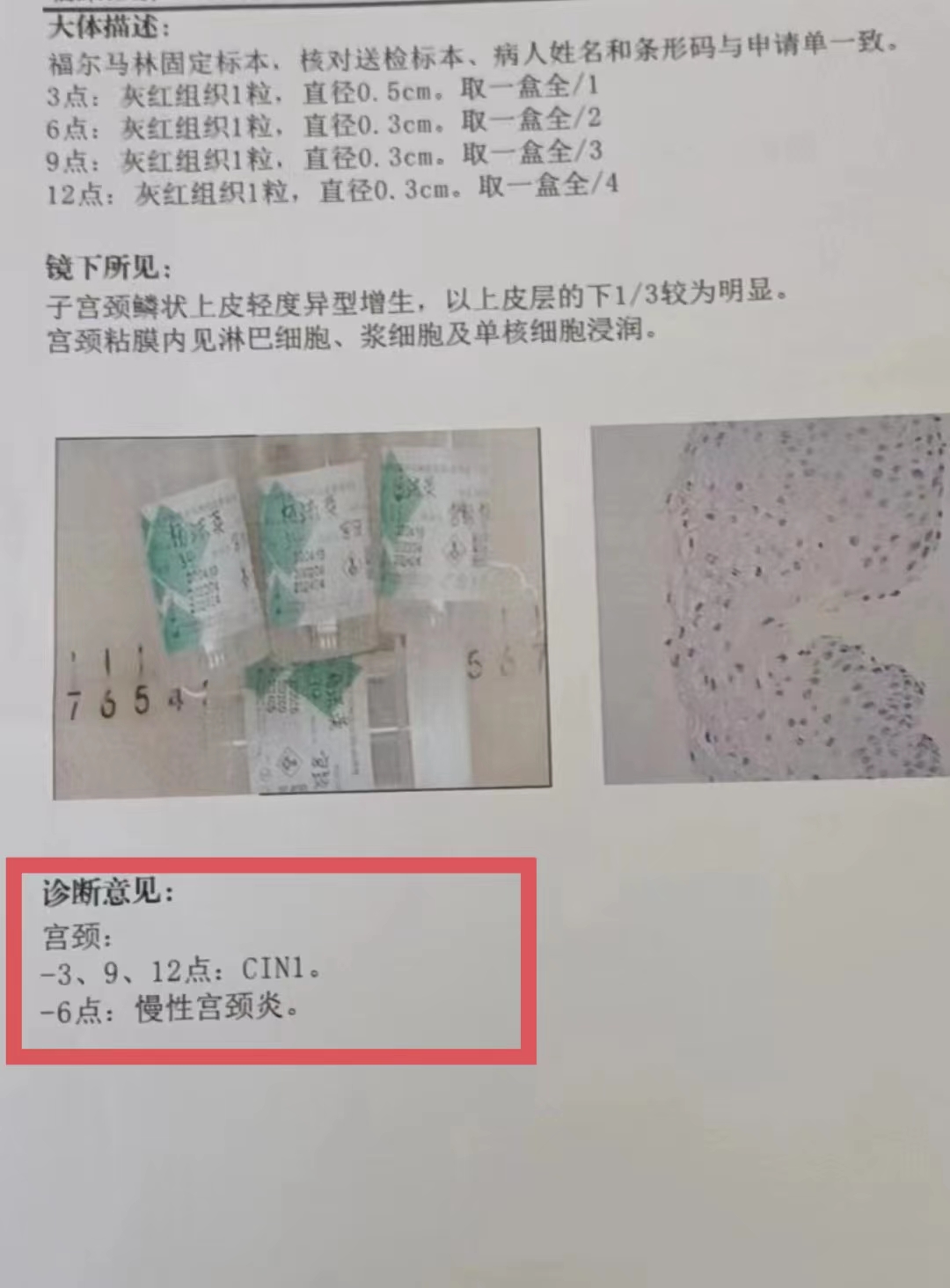 今天给大家介绍一个中药颗粒每天饭后一袋hpv就能慢慢代谢掉
