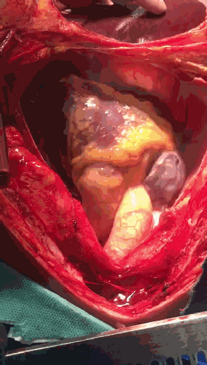 其中一位女性患者在心脏不停跳的情况下,通过微创手术完成人工心脏的