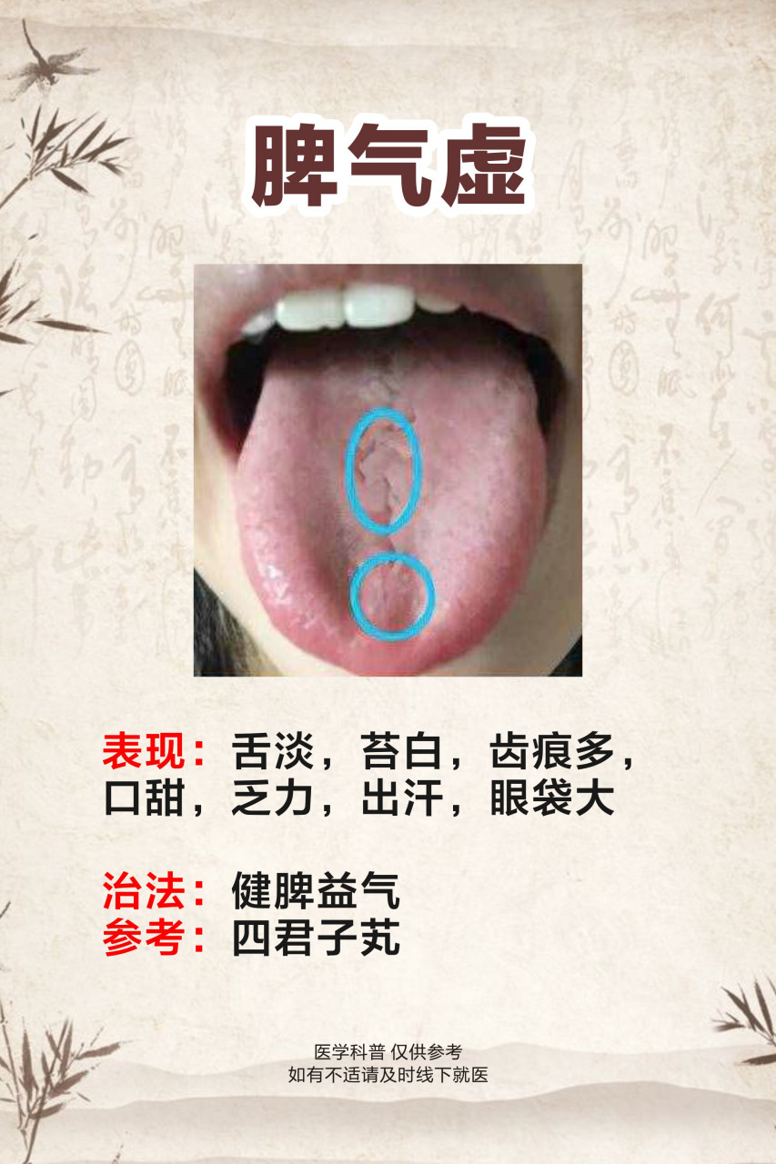 脾虚是指脾虚引起的一系列症状,包括脾气虚,脾阳虚,中气下陷,脾不统血