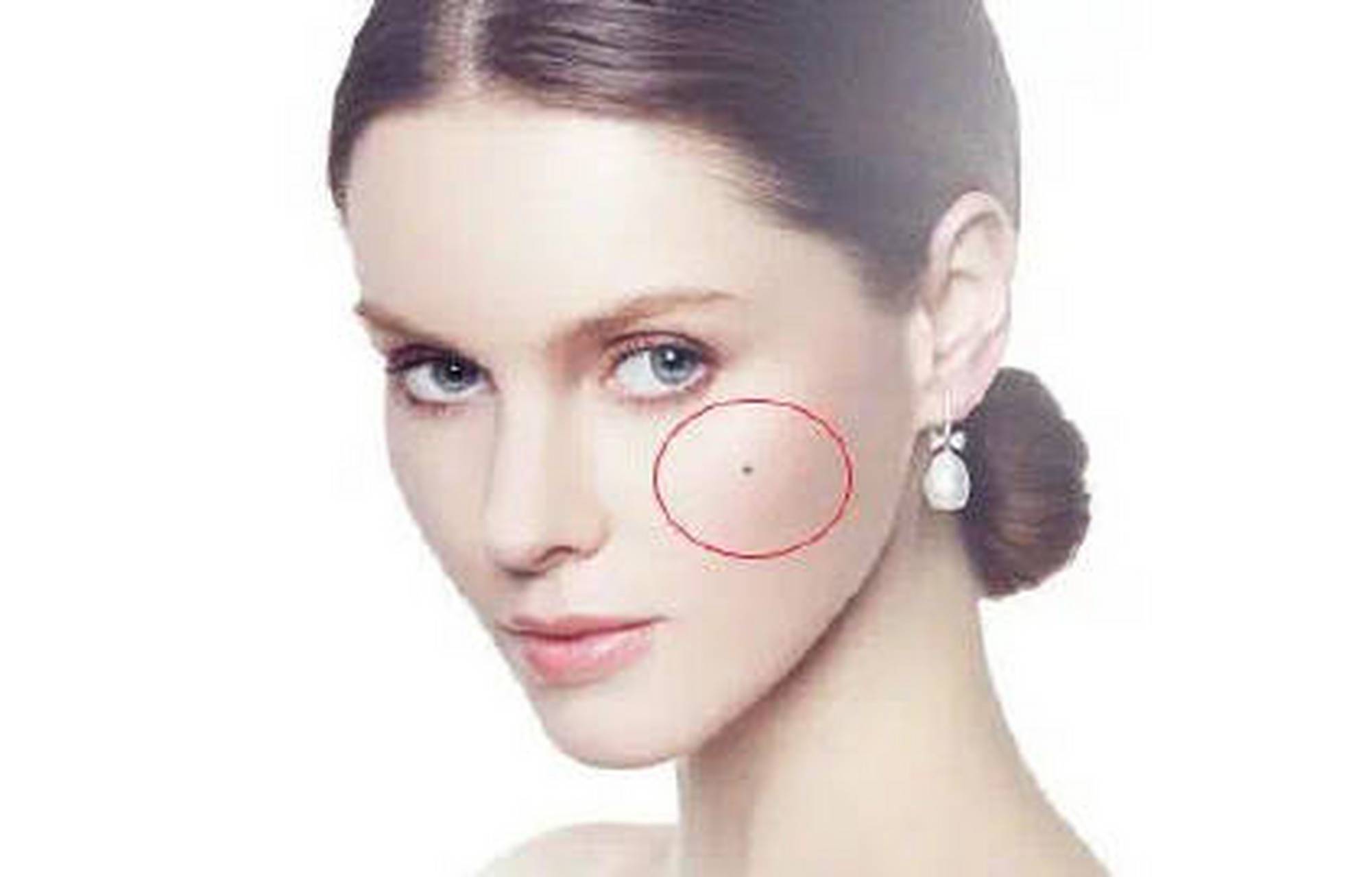 颧骨痣:  事业易成        颧骨露出的人,大多有争取向上而积极的奋斗