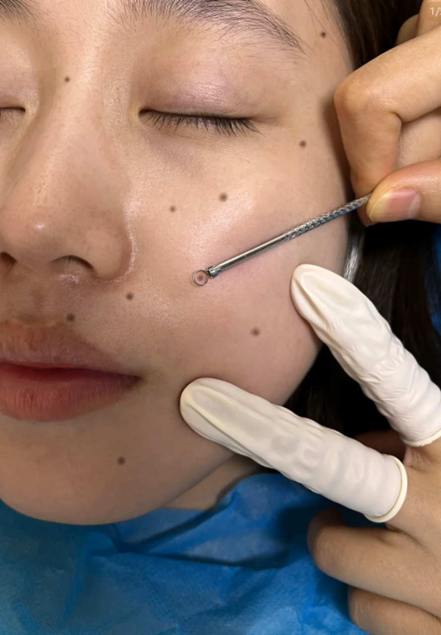 激光去痣疤痕是现代美容技术中比较常规的一种方法,它可以有效去除