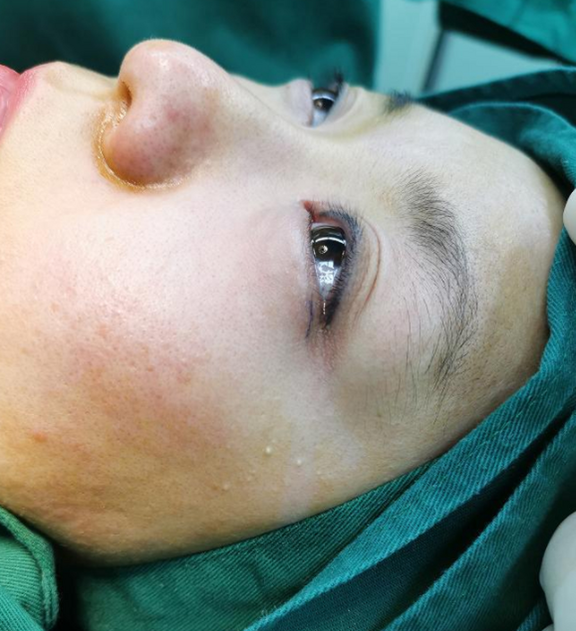 下图这位女患者下眼睑下垂,退缩,呈现三白眼,做完手术后眼神都变得