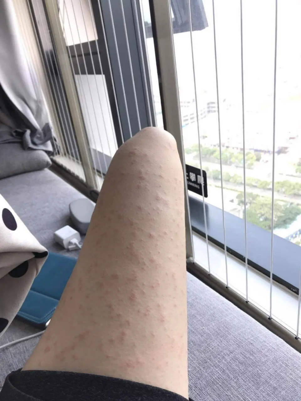 今天给大家介绍三味狠药,可以帮助我们很好的缓解慢性湿疹和它所导致