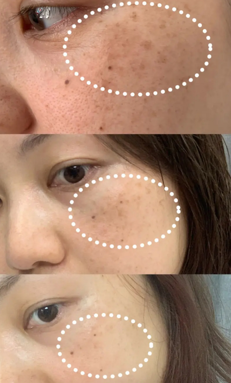 激光祛斑# 黄褐斑和雀斑的区别 黄褐斑和雀斑是两种不同的皮肤问题