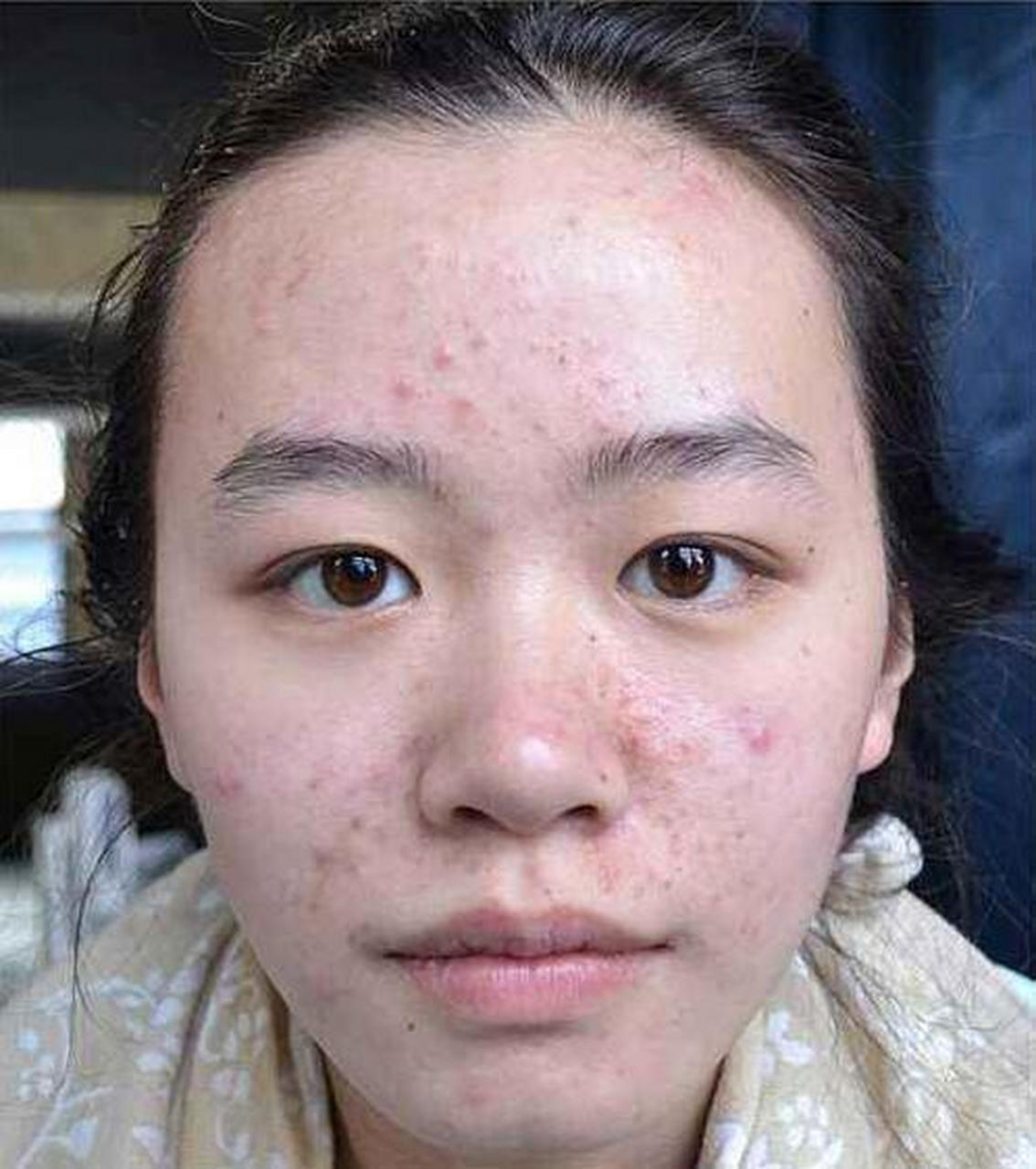 【患者提问】我的脸上总是会长痘,到医院做检查医生