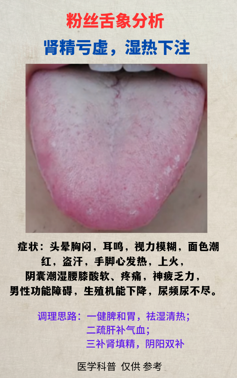 粉丝舌象分析:肾精亏虚,湿热下注#中医男科# #湿热下注