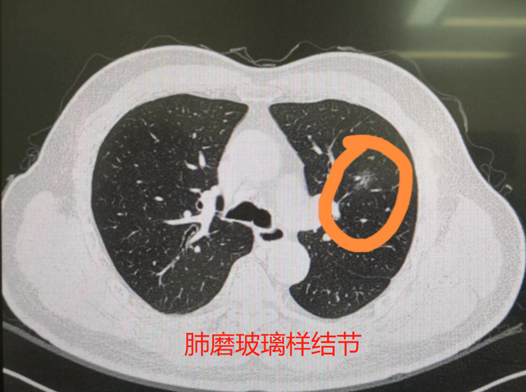 这些这些磨玻璃结节,一般是根据它的密度和均匀程度来区分的,一般磨