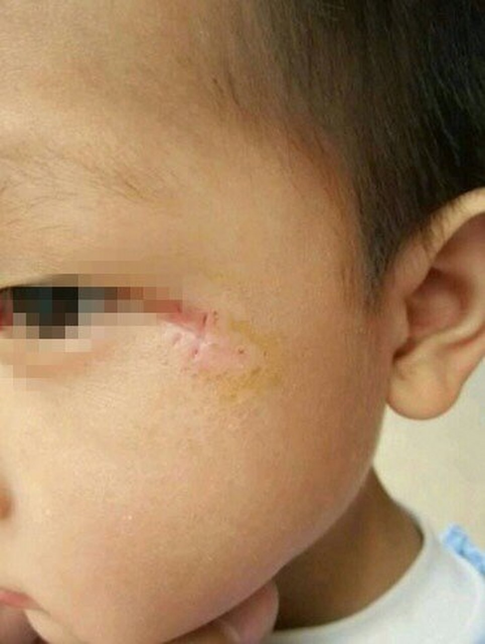 去除胎记的方法较多,包括冷冻,电凝,激光,微波,放射治疗,同位素治疗