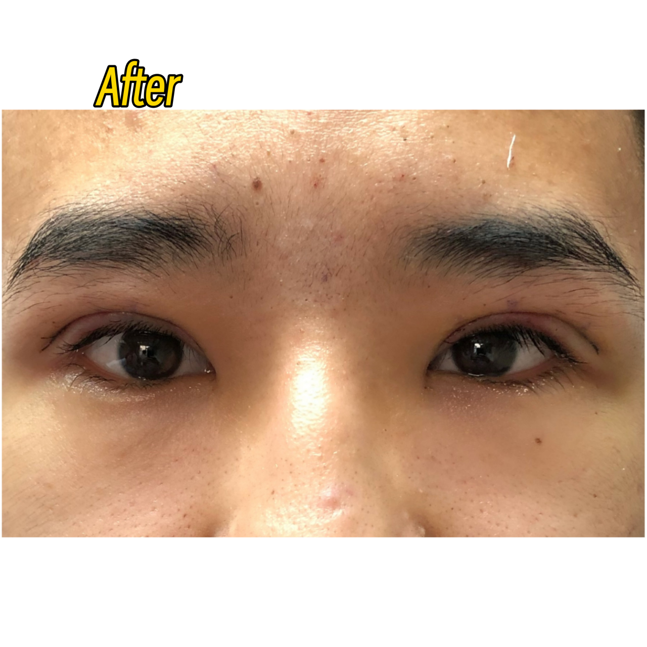 三角眼给人的感觉:老气,疲惫,无神  #全切双眼皮