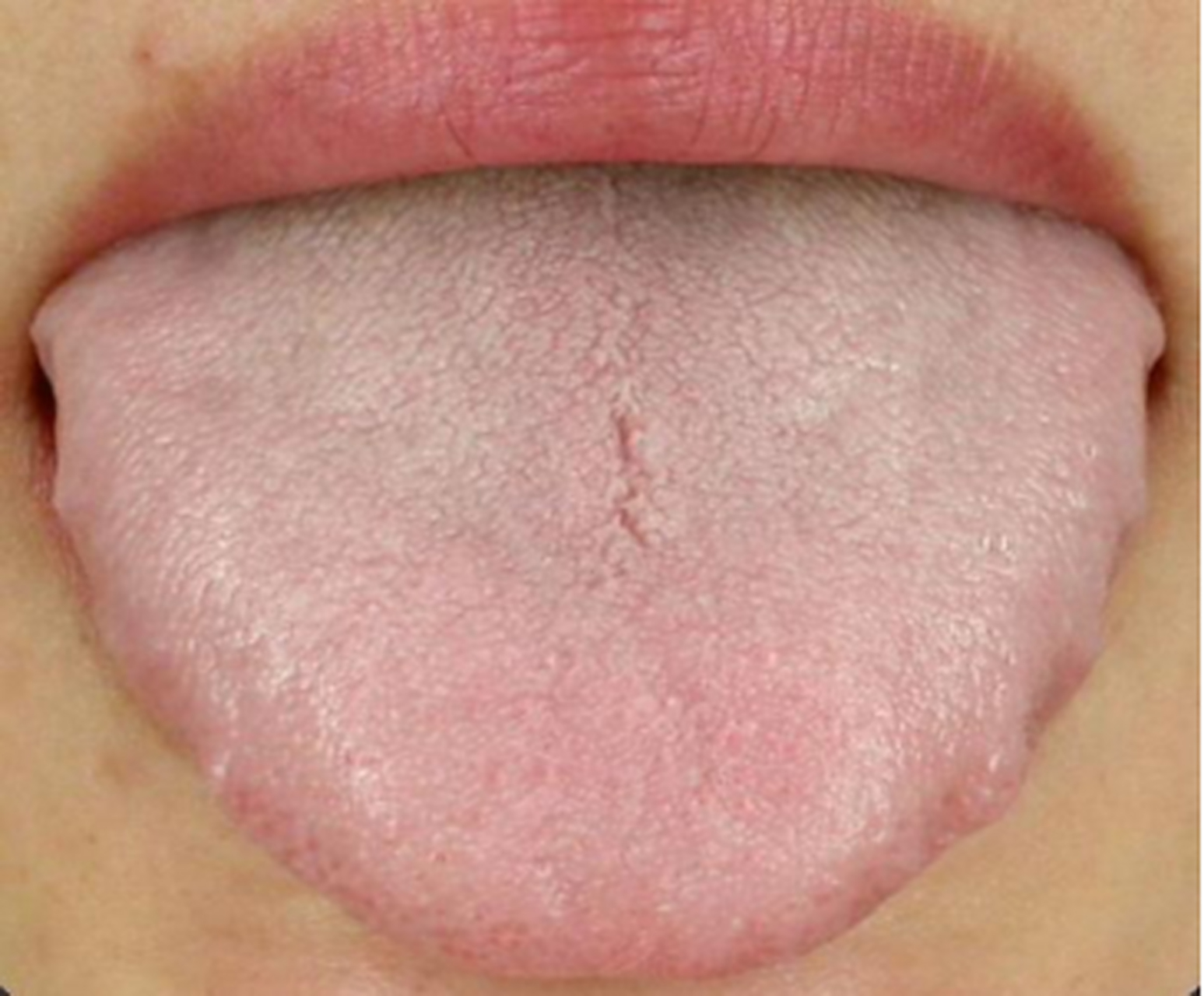 首先这个舌头整体颜色偏白,寡淡,舌头干瘪不饱满,说明气血不足