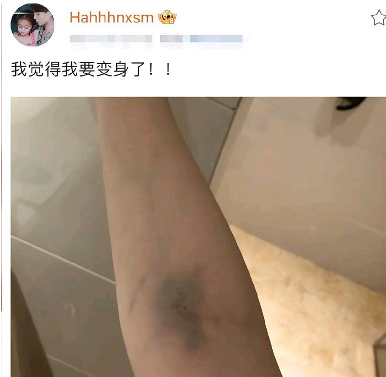 晒出自己膝盖受伤的照片,瘦弱的一双膝盖上,好几处大的淤青和伤口