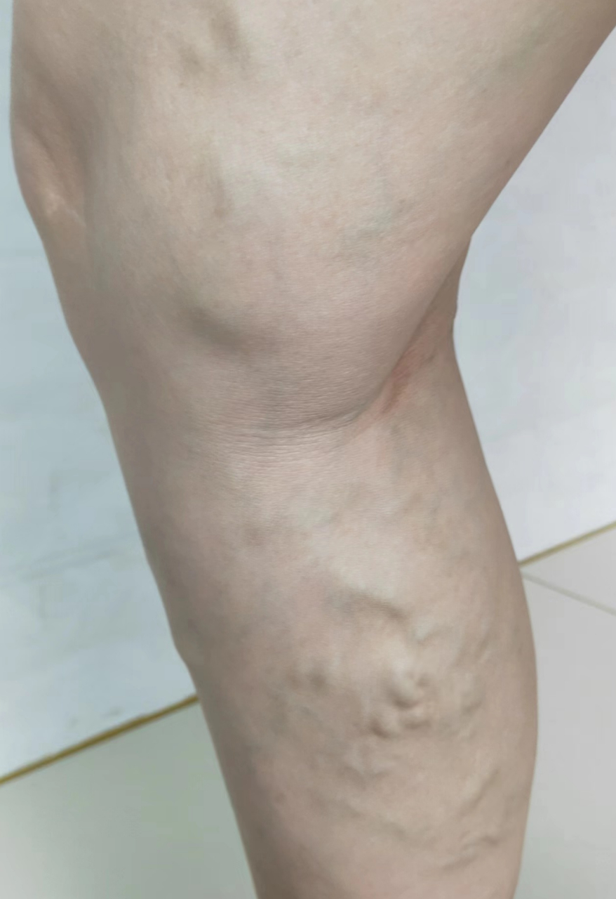 静脉曲张的症状 1.