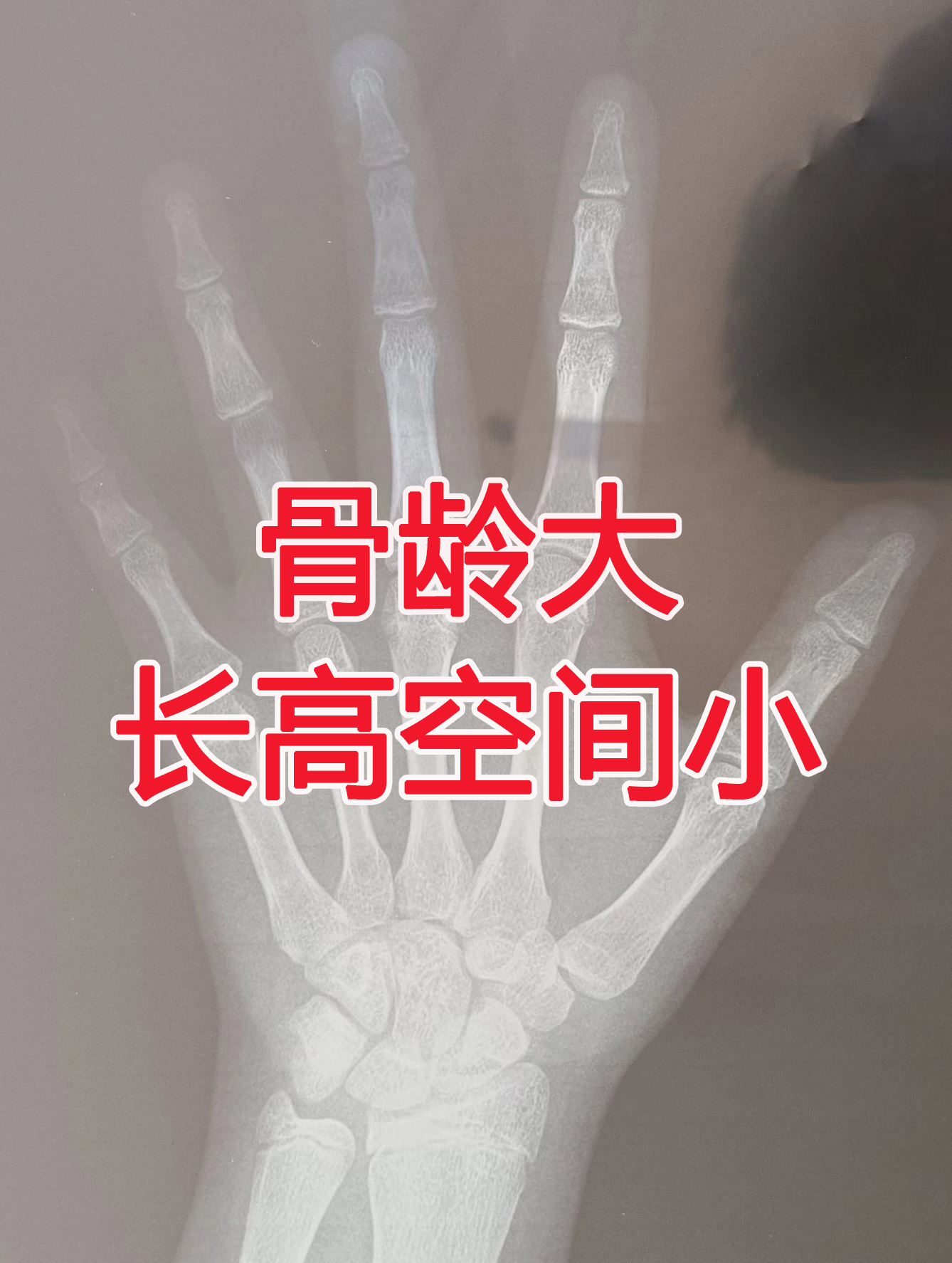 请您帮帮我务必 15岁的男孩骨龄15岁男孩骨龄图片15岁骨龄片图片