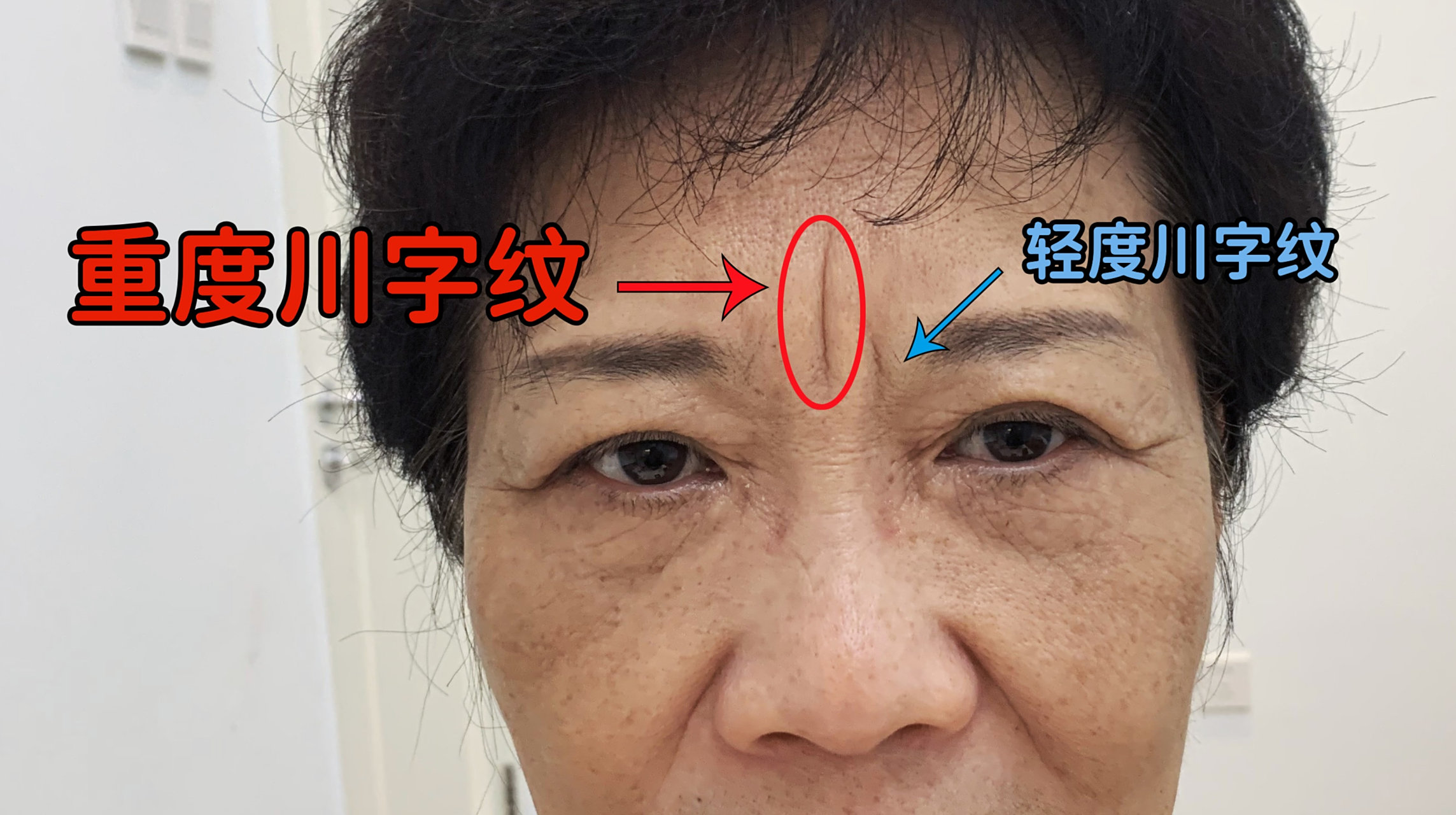 除皱针有效抑制肌肉的运动.