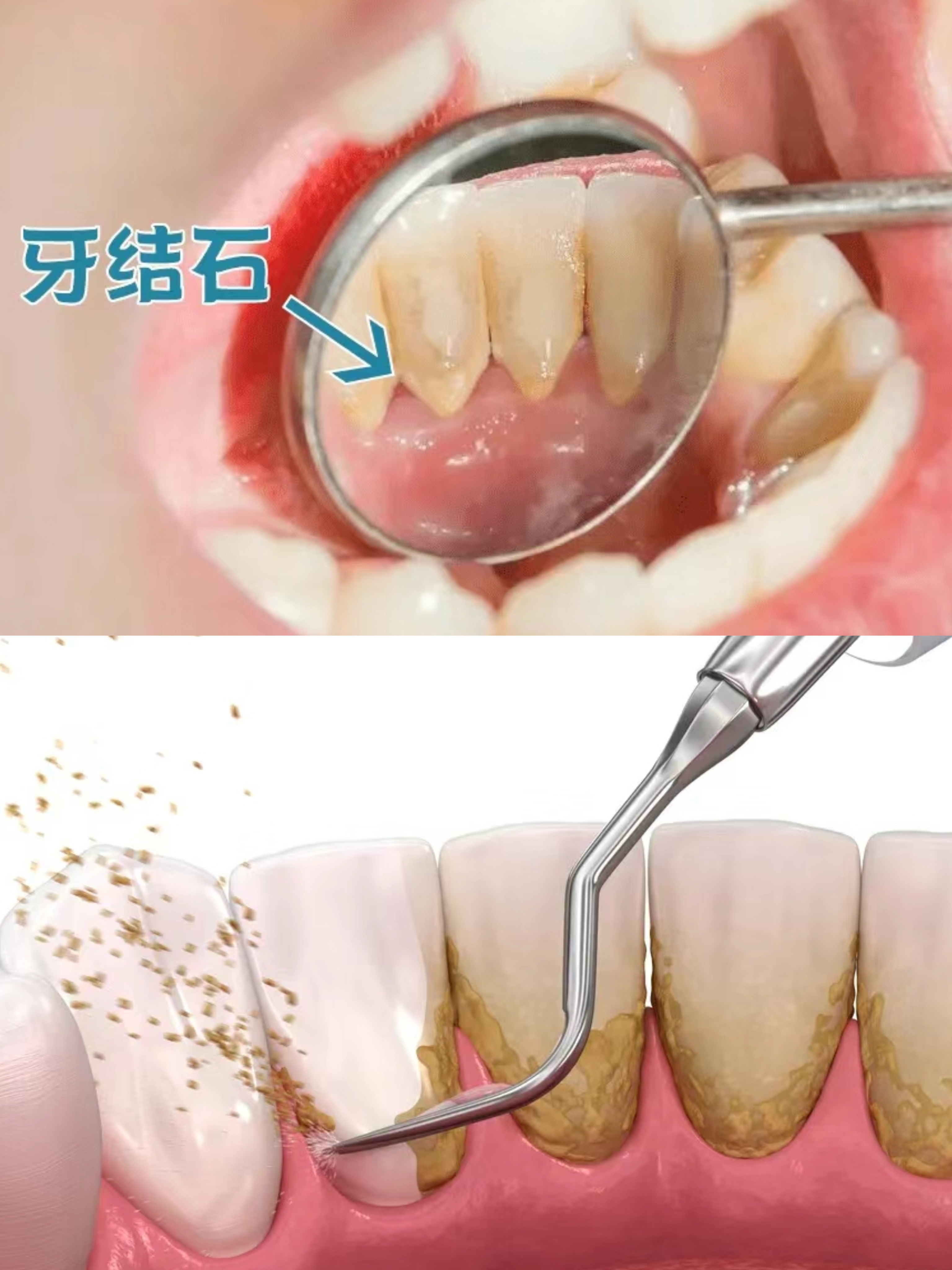 我们有没有必要定期去超声波洗牙