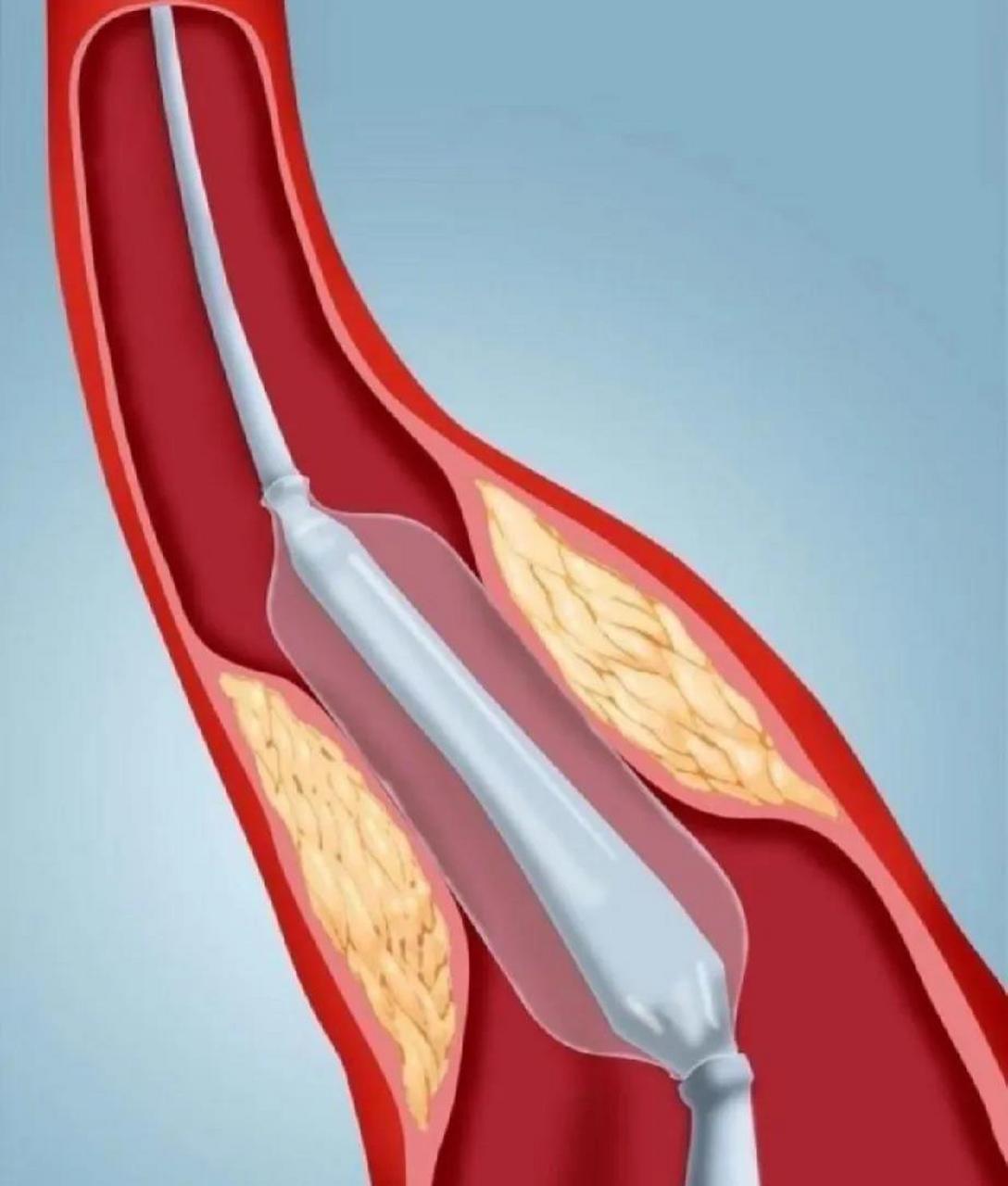 前因为冠状动脉前降支近段发生高度狭窄,在当地医院做了心脏支架手术