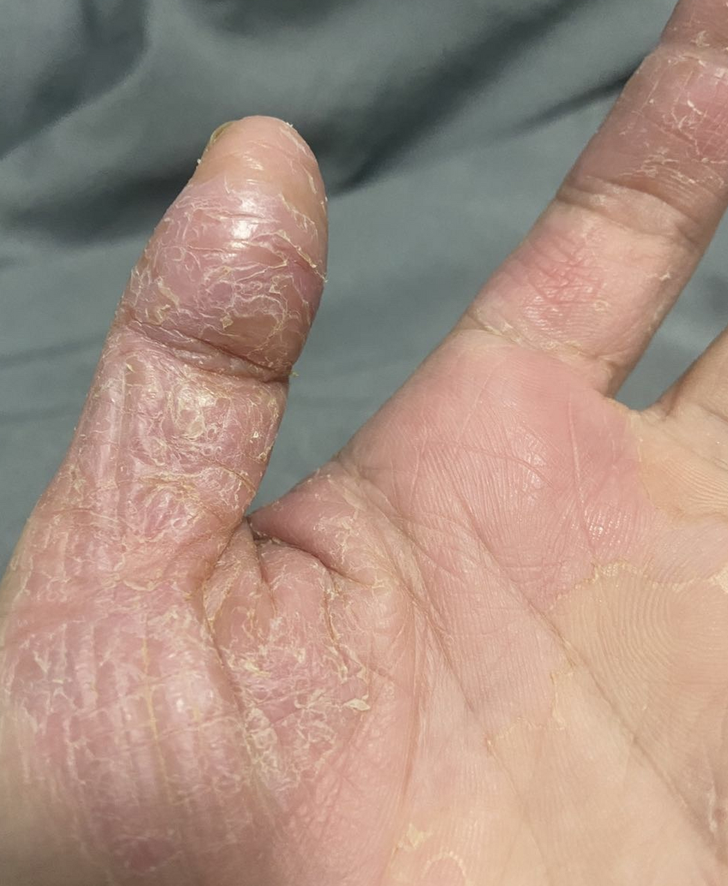 双手粗糙,脱皮,还有裂口,又痒又痛 ?这个就是手部慢性湿疹!