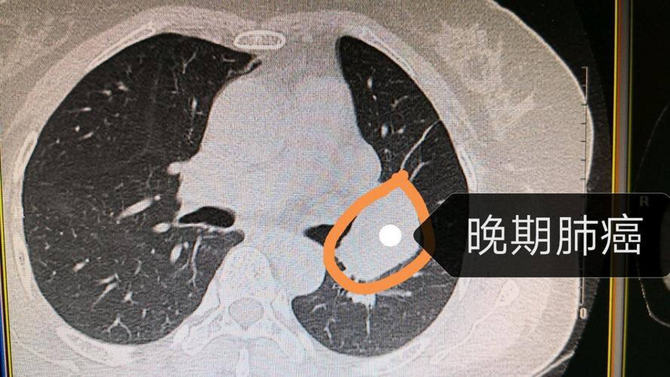 肺癌晚期肺的图片图片