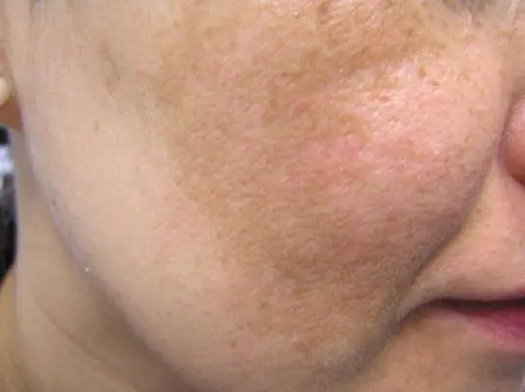 黄褐斑是一种常见于面部皮肤的色素沉着,严重影响患者的容貌及身心