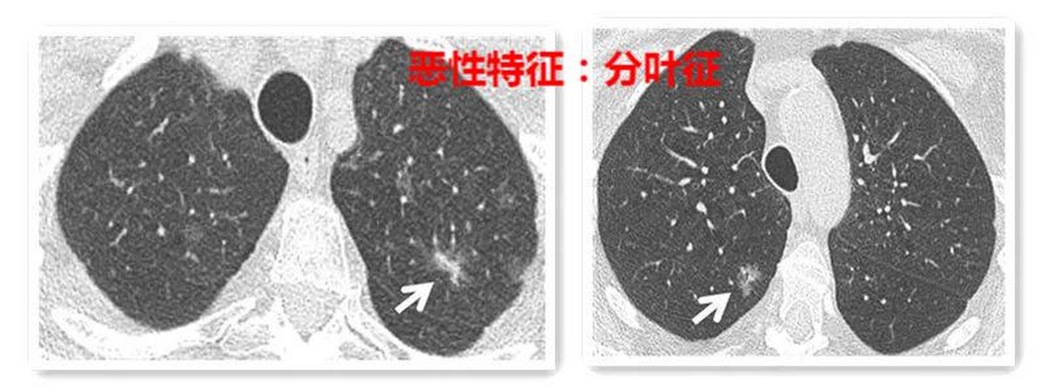 肺脏分叶图片