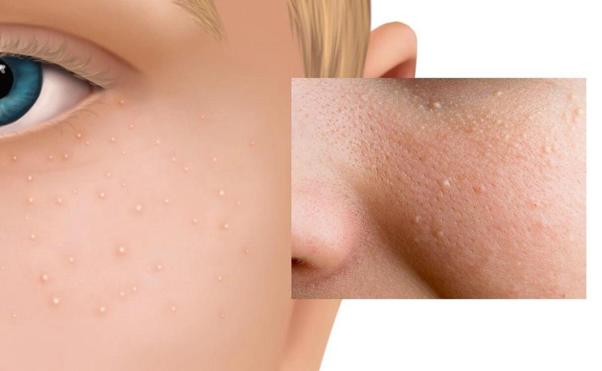 粟丘疹又称白色痤疮或粟丘疹白色苔藓,是起源于表皮或附属器上皮的