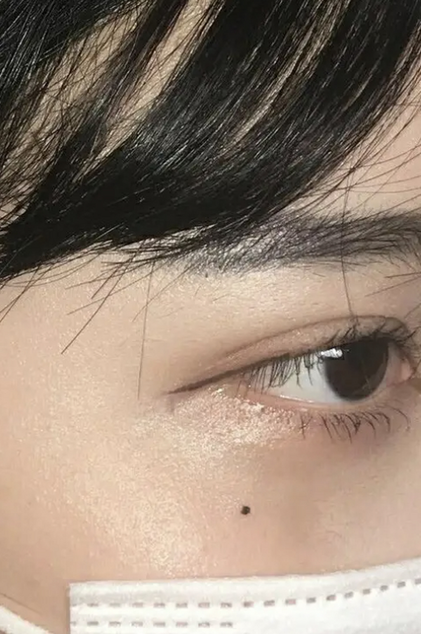 激光点痣# 哭痣怎么去掉 哭痣,或者叫做泪痣,是长在太阳穴和胫骨最高