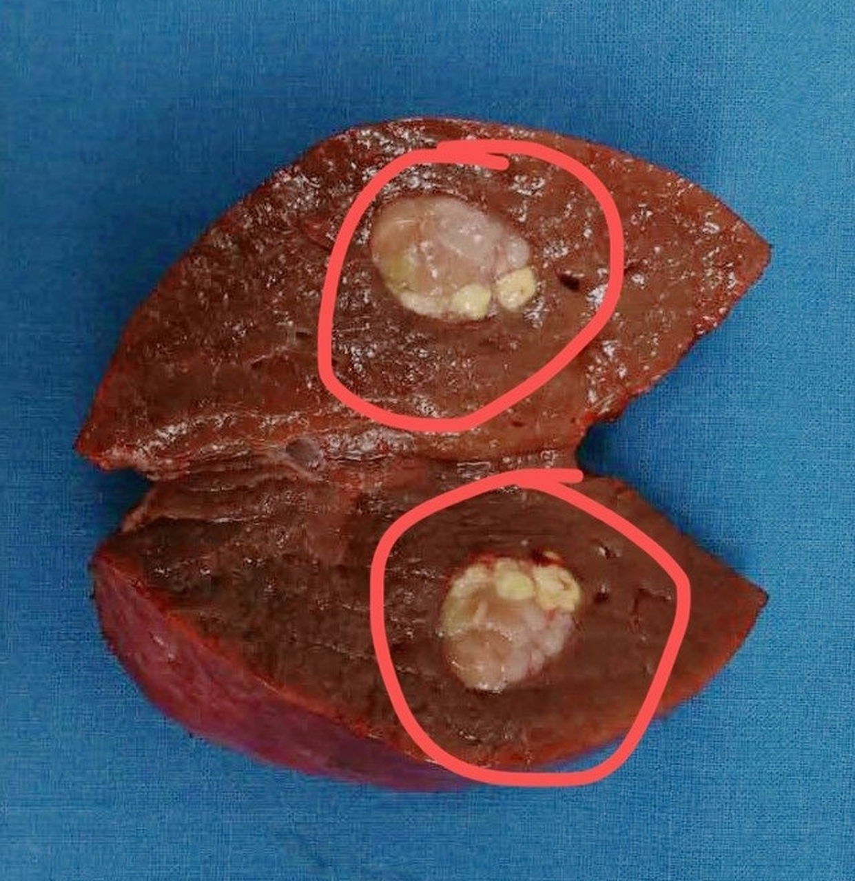 来看看号称癌中之王的肝癌长什么样?