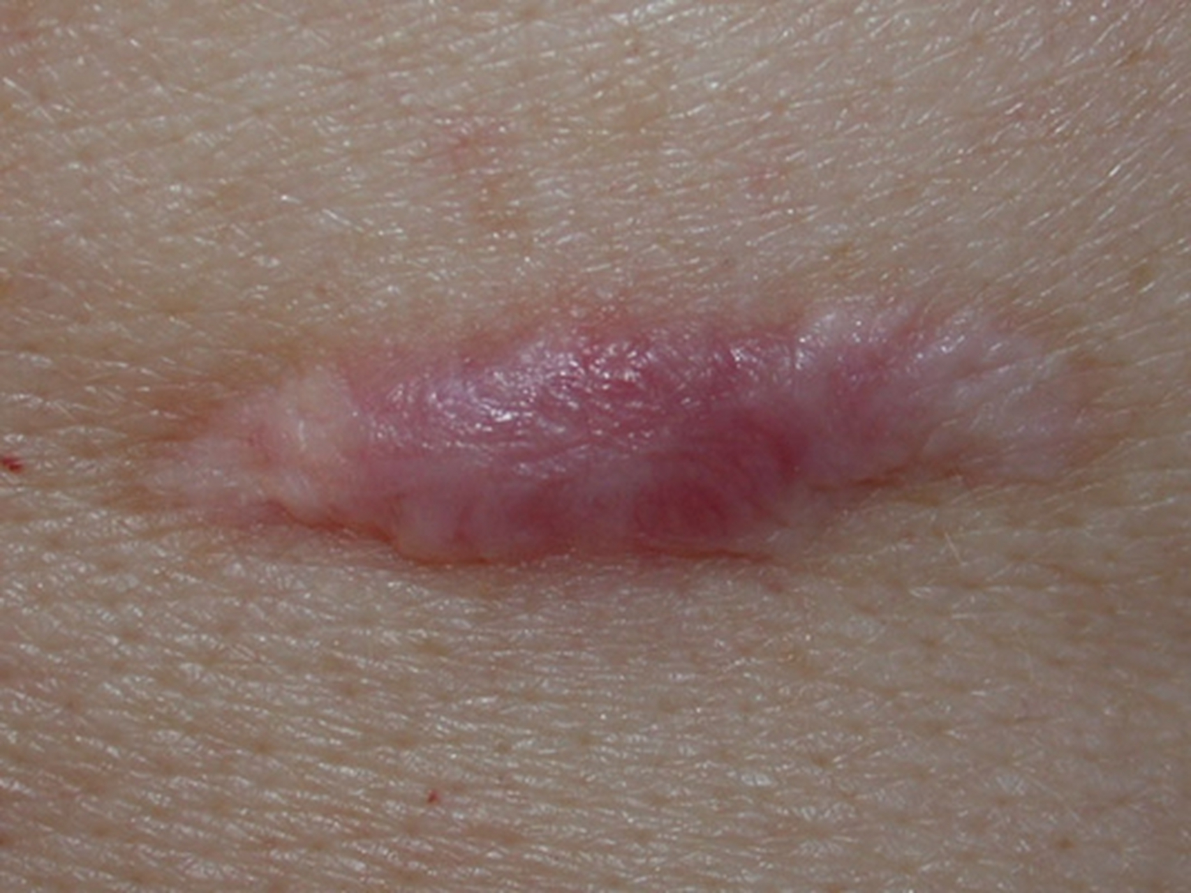 目前的医疗技术,还无法达到根治瘢痕疙瘩的效果,但可以做到预防.