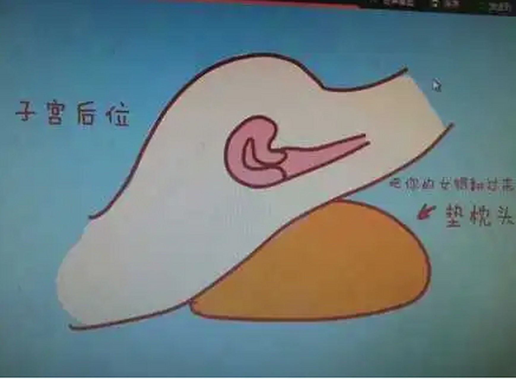 子宫后位可积极纠正.