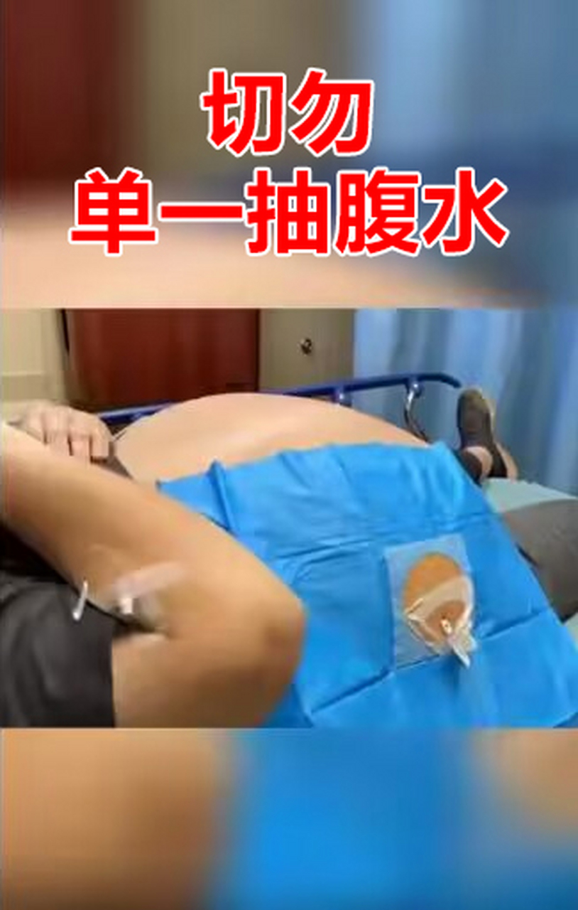 来了一位顽固性腹水患者,在当地治疗一年,反复抽水,但紧接着肚子又大