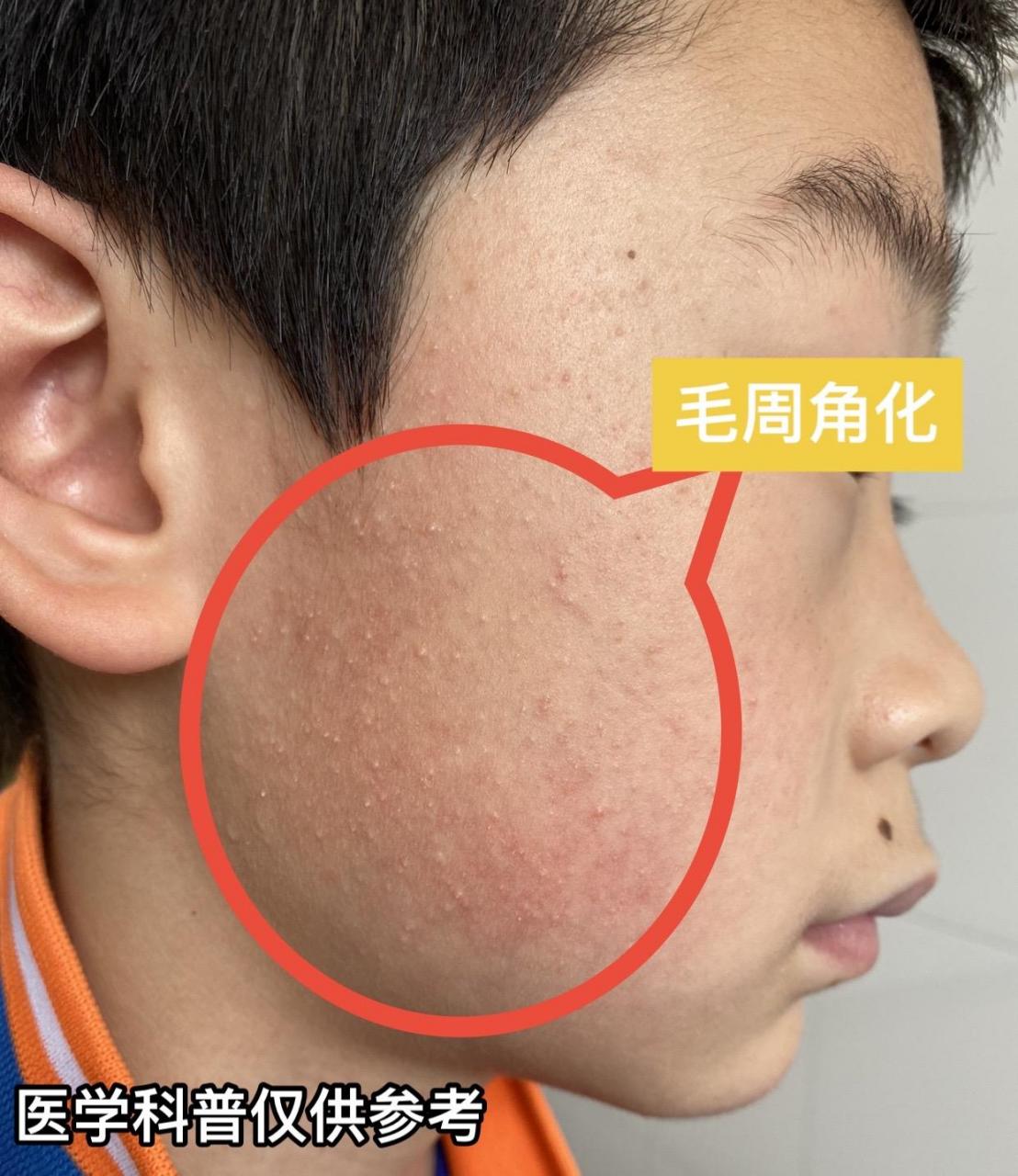 毛周角化症# #鸡皮肤# #皮肤问题# #健康