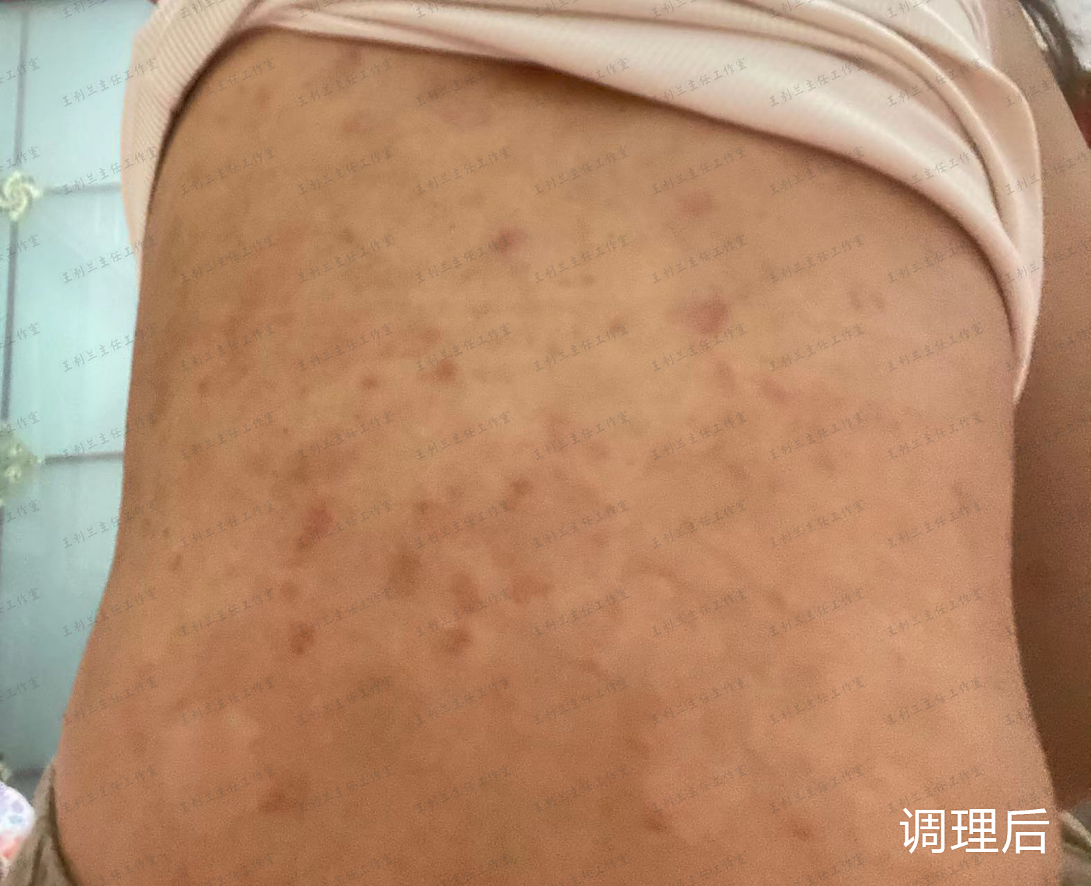 姑娘长满背的红斑,医生一问,原来是自制药膏刺激皮损加重!