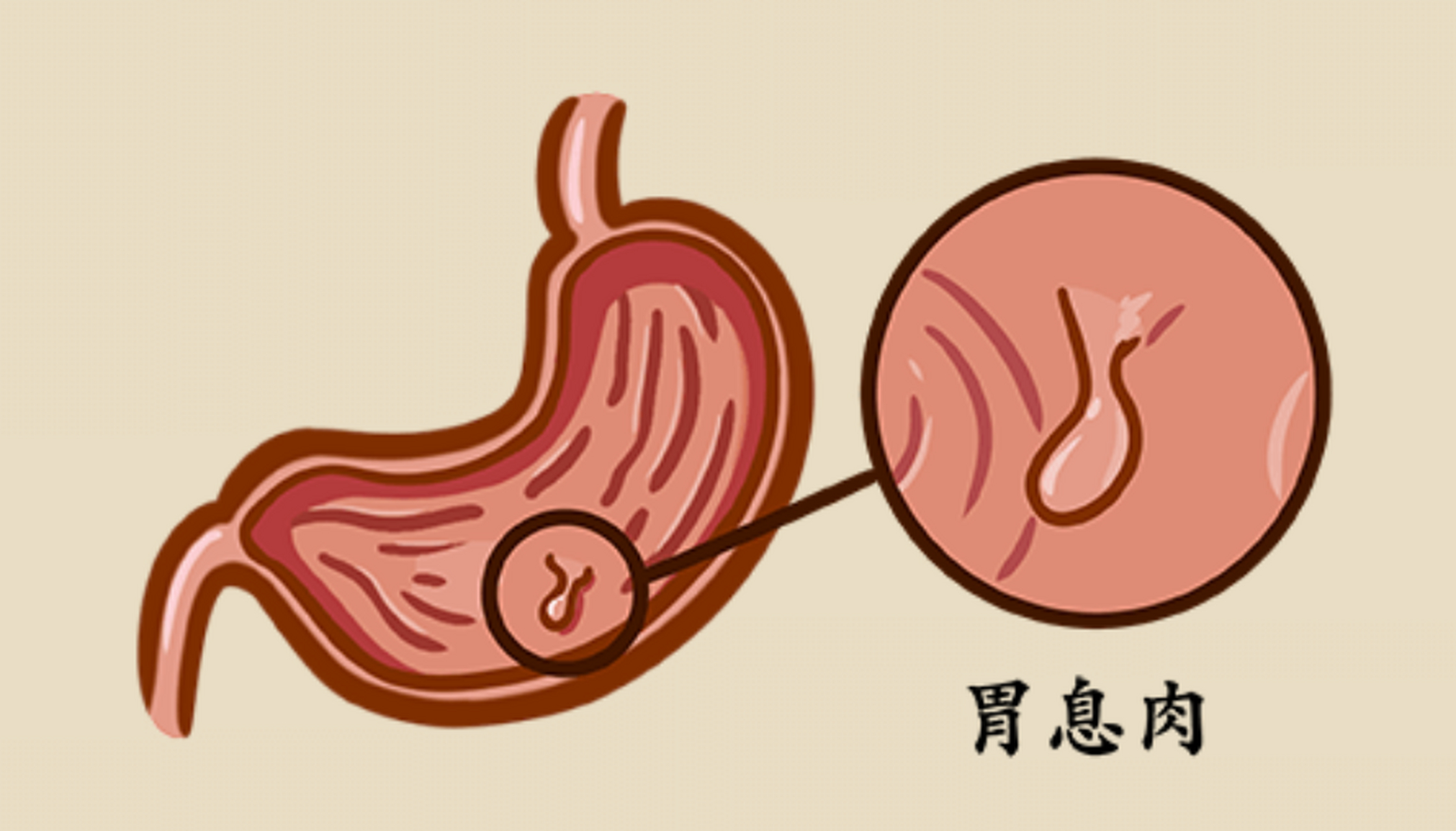 胃息肉先别慌,弄清这几个问题!