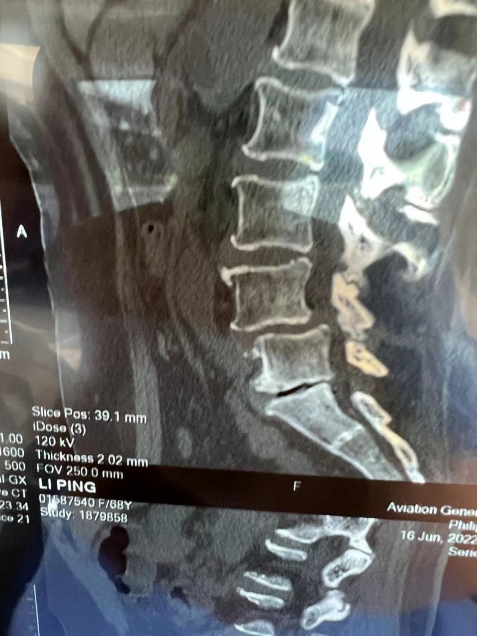 我已嘱咐其继续坚持锻炼,并避免腰椎的过度活动及损伤.