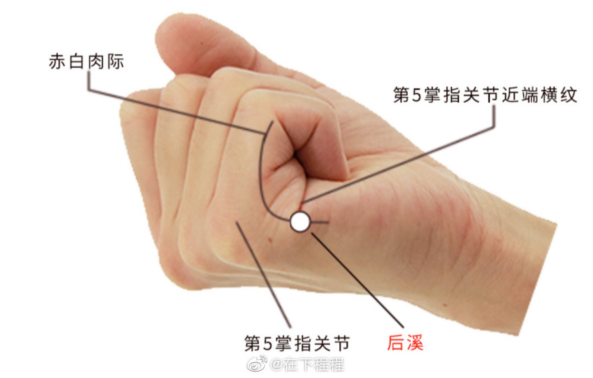 【后脑勺疼】后脑勺疼,找双侧后溪穴和双侧束骨穴.