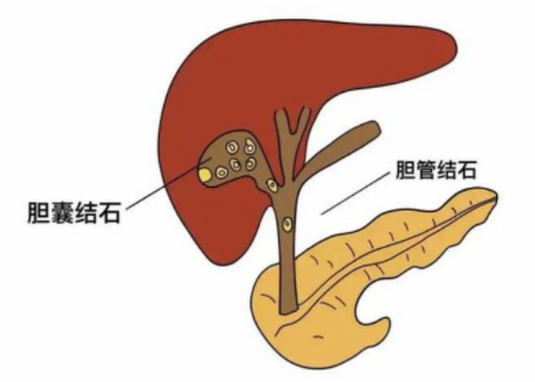 胆结石排出的方法保胆取石术:通过手术在肚子上开个1cm左右的小切口