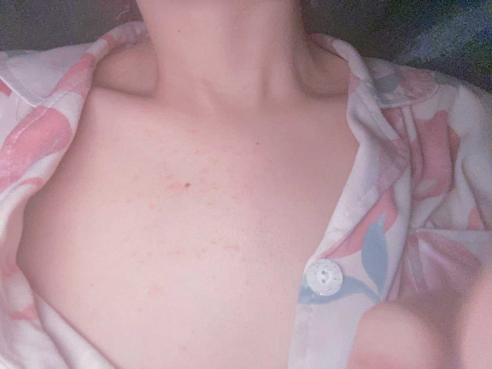 女,21岁,周末晚上喝了点rio,昨天晚上洗澡发现胸口有红色的